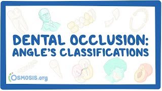 Dental occlusion  Angle’s classifications [upl. by Spalding]