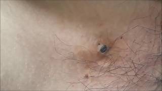 LATEST Blackheads Comedones  EXTRACTION 25 DECEMBER 2017 [upl. by Ania957]