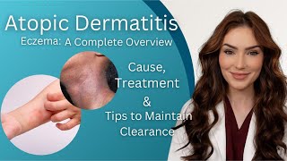 Atopic Dermatitis  Diagnosis Treatment and Maintenance Tips [upl. by Asirral]