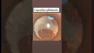 Eye Diseases Capsular phimosis education shortsvideo viral shorts optometry eyes [upl. by Ayekim]