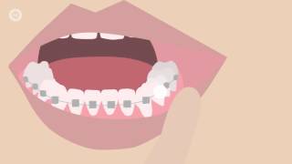 How To Deal With Braces Discomfort  Whats Normal Whats Not amp What To Do [upl. by Ellened]