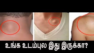 உங்க உடம்புல இது இருக்கா  Lipoma health tips Tamil [upl. by Helbonna531]