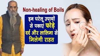 फोड़े फुंसी को पकाएंगा ये नुस्खादर्द लालिमा से भी मिलेगी राहत  Nonhealing of boils Treatment [upl. by Riancho]