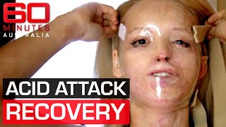 Acid attack survivors inspirational journey to recovery  60 Minutes Australia [upl. by Nav]