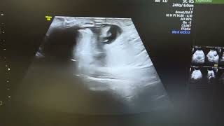 Ultrasound of strangulated umbilical hernia showing omental herniation with fluid [upl. by Ococ193]