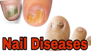 Nail diseases l Homoeopathy Medicine l Nail Fungus Treatment [upl. by Rex]