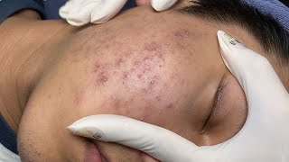 ACNE TREATMENT VU QUYNH MI Acne On Teens Chin 2024 [upl. by Muldon]