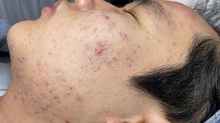 ACNE TREATMENT VU QUYNH MI  Blackheads Of Tweens 2024 EX [upl. by Urquhart]