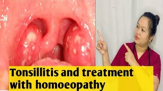 Tonsillitis😱😱signs amp symptoms and its treatment with homoeopathy ✅🍀💯 [upl. by Uohk]