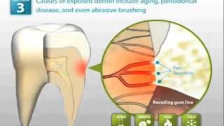 Demineralized Tooth Enamel Dynamics of Treatment [upl. by Stefanac]