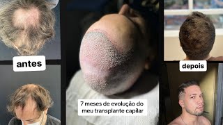 TRANSPLANTE CAPILAR ANTES E DEPOIS DE 7 MESES DE EVOLUÇÃO [upl. by Can]