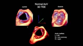 3D Echocardiography Acquisition Cropping and Case Examples [upl. by Addiego]