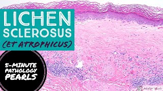 Lichen Sclerosus et Atrophicus 5Minute Pathology Pearls [upl. by Graehme]