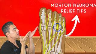 Relieve Morton’s Neuroma Pain Best Tips and Tricks [upl. by Nellek310]