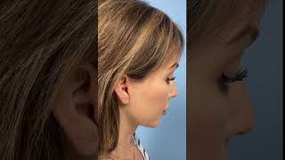 Deep Plane Facelift and Neck Lift 5 Weeks Out  Bay Areas Best Facial Plastic Surgeons  Drs LampP [upl. by Amri]