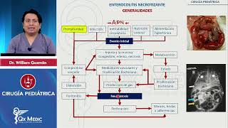 Enterocolitis necrotizante CIRUGÍA PEDIATRÍA INDICE DESCRIPCIONETIOLOGIACLINICATTO QXMEDIC [upl. by Annatnom]