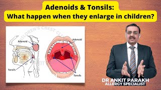 Adenoids amp Tonsils What happen when they enlarge in children I Dr Ankit Parakh Child Pulmonologist [upl. by Dlarrej]