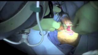 Parathyroidectomy with Intraoperative MRI and ThreeDimensional Navigation [upl. by Glyn92]