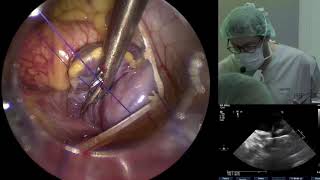 Totally Endoscopic Aortic Valve Replacement [upl. by Fleurette216]