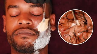 EXTREME Beard Care with SATISFYING Ingrown Hair removal [upl. by Whitelaw]