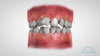 3D Animation showing teeth movements [upl. by Petronia488]