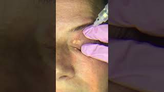 Xanthelasma removal [upl. by Sualakcin]