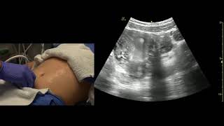 Transabdominal Pelvis Ultrasound Scanning Techniques [upl. by Anreval]