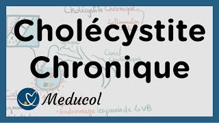 Cholécystite chronique calcul vésicule biliaire symptômes inflammation et cholécystectomie [upl. by Llertnod734]