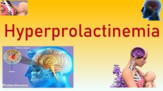 Hyperprolactinemia  Causes Symptoms Clinical Features Diagnosis Investigations and Management [upl. by Nero]