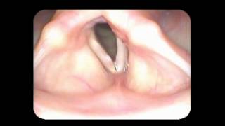 Vocal cord paralysis with nodules [upl. by Andrea]