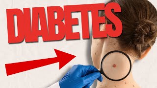 10 UNEXPECTED Signs Of Diabetes On The Skin [upl. by Eisseb754]