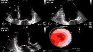 DOBUTAMINE STRESS ECHO MITRAL REGURGITATION  ECHOCARDIOGRAPHY cardiac ultrasound [upl. by Claiborn878]