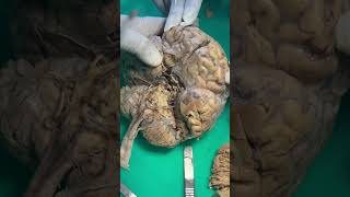 Brainstem dissection [upl. by Tamsky]