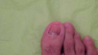 TOENAIL FUNGUS DOCUMENTARY DAY 15 [upl. by Ganny]