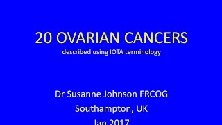 20 ovarian cancers for YouTube 2017 [upl. by Yrogerg]