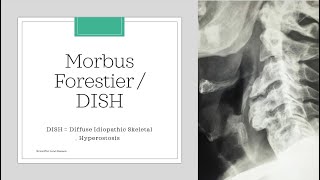 Morbus Forestier  DISH Diffuse idiopathic skeletal hyperostosis Essential medicine [upl. by Ettenauq]