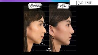 How to choose the best filler Juvederm vs Radiesse  Wave Plastic Surgery [upl. by Anairam]