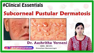 Subcorneal Pustular Dermatosis  Clinical Essentials   Dr Aashritha yerneni [upl. by Ydniahs332]