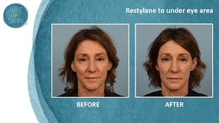 Undereye filler with Restylane Dr Palm San Diego [upl. by Yendroc]