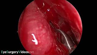 Middle turbinate concha bullosa excision [upl. by Llenram722]