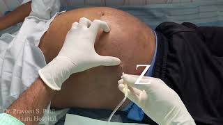 ABDOMINAL PARACENTESIS  ASCITES [upl. by Purity]