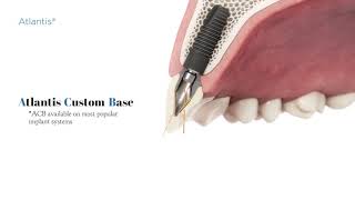 Absolutes Guide to ASA Angulated Screw Access by Dentsply Sirona [upl. by Torras]