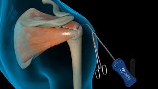 ConMed Linvatec Rotator Cuff Shoulder Surgery [upl. by Allys]