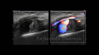 Axillary artery Pseudoaneurysm [upl. by Yole340]