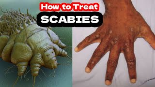 Scabies Causes Symptoms and Treatment of Scabies [upl. by Mauceri361]