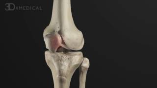 Anterior Cruciate Ligament Pathology and Management  Animated Tutorial [upl. by Tallulah]