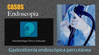 Gastrostomia endoscÃ³pica percutÃ¡nea [upl. by Connolly]