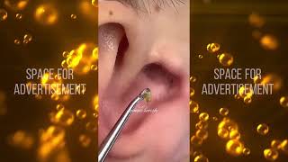 30 minutes of Pimple Popping Compilation [upl. by Acisset883]