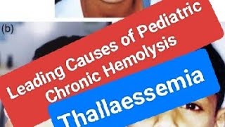 Leading Causes of Pediatric Chronic Hemolysis [upl. by Charo49]