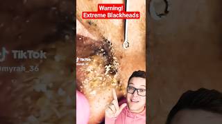 Warning EXTREME BLACKHEAD REMOVAL  How Do You Tackle This shorts [upl. by Keffer184]